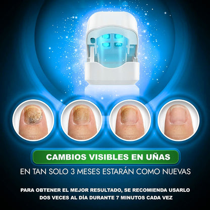 Laser Para Tratamiento De Uñas comprexia™